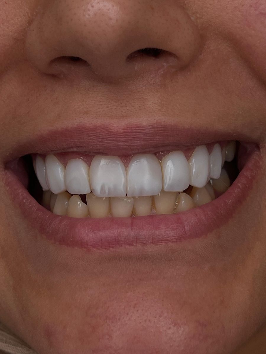 Porcelain veneers, before treatment