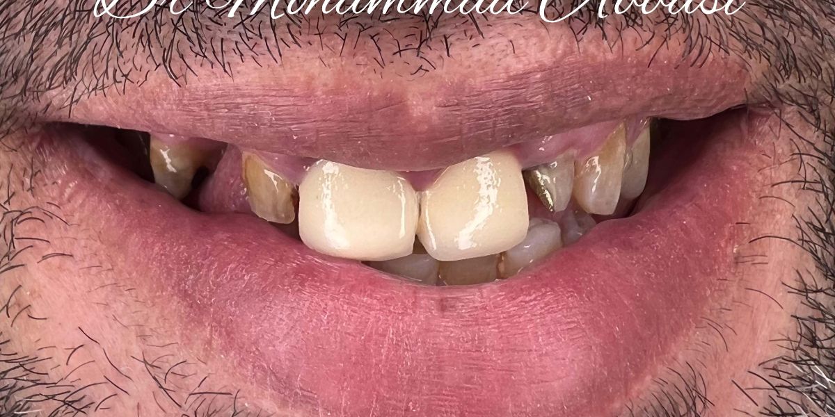 Porcelain veneers, before treatment