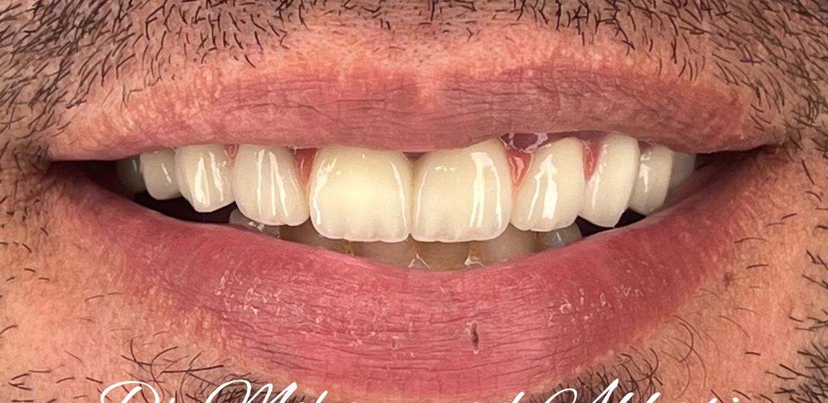 Porcelain veneers, after treatment