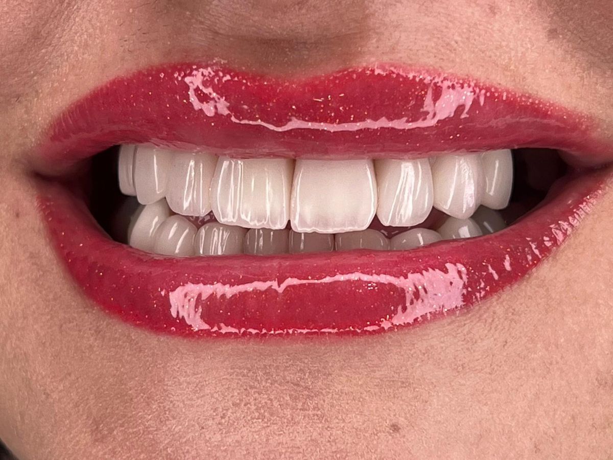 Porcelain veneers, after treatment