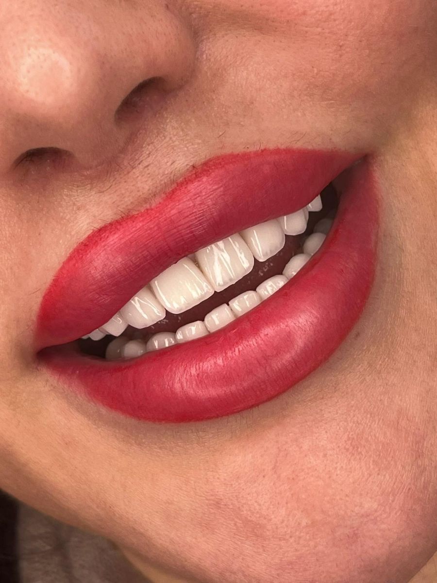 Porcelain veneers case 7, after treatment