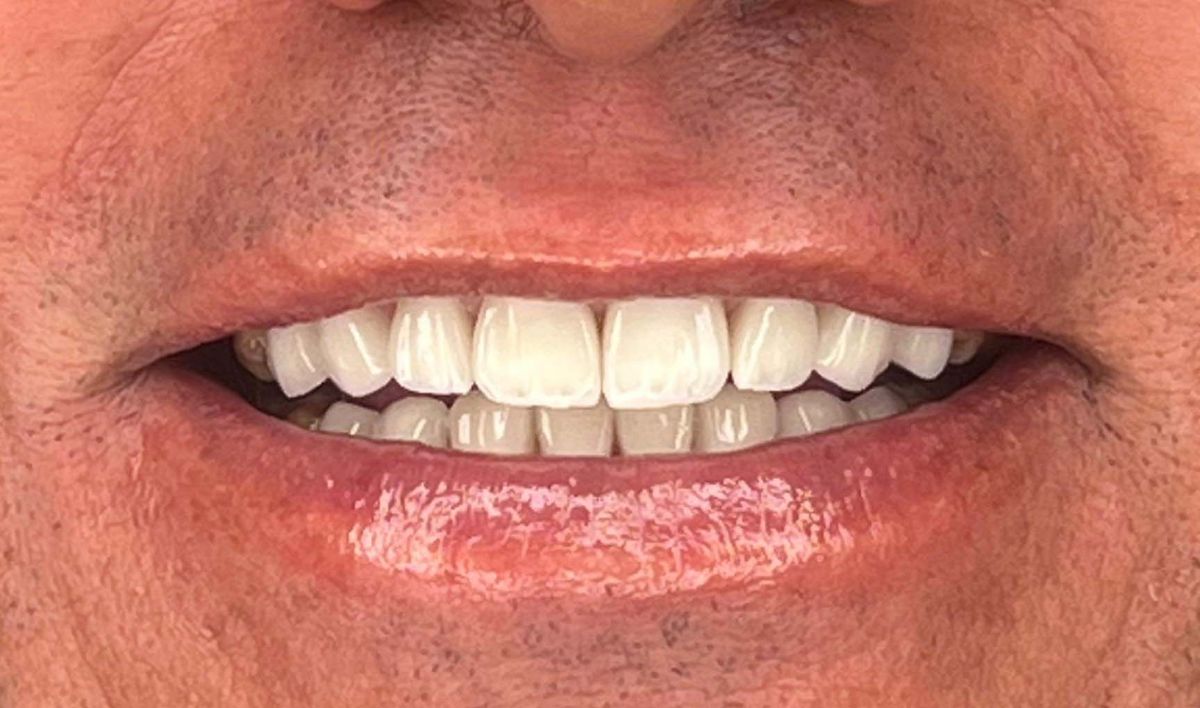 Porcelain veneers case 8, after treatment