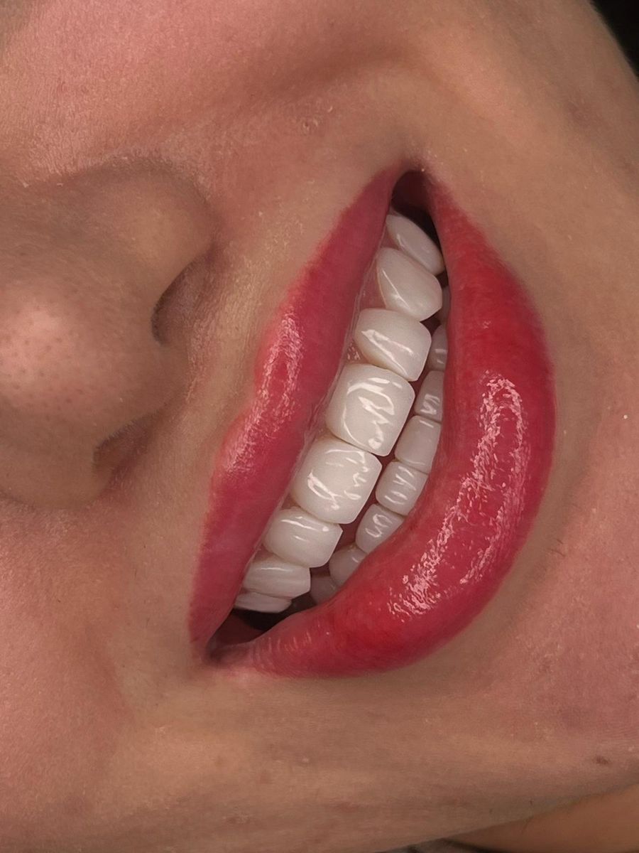 Composite bonding, after treatment