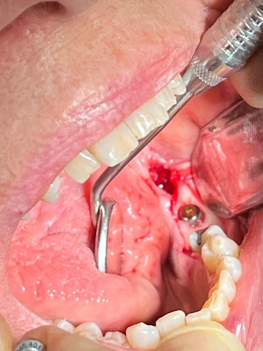 Dental implant case 1, stage 2 of 4