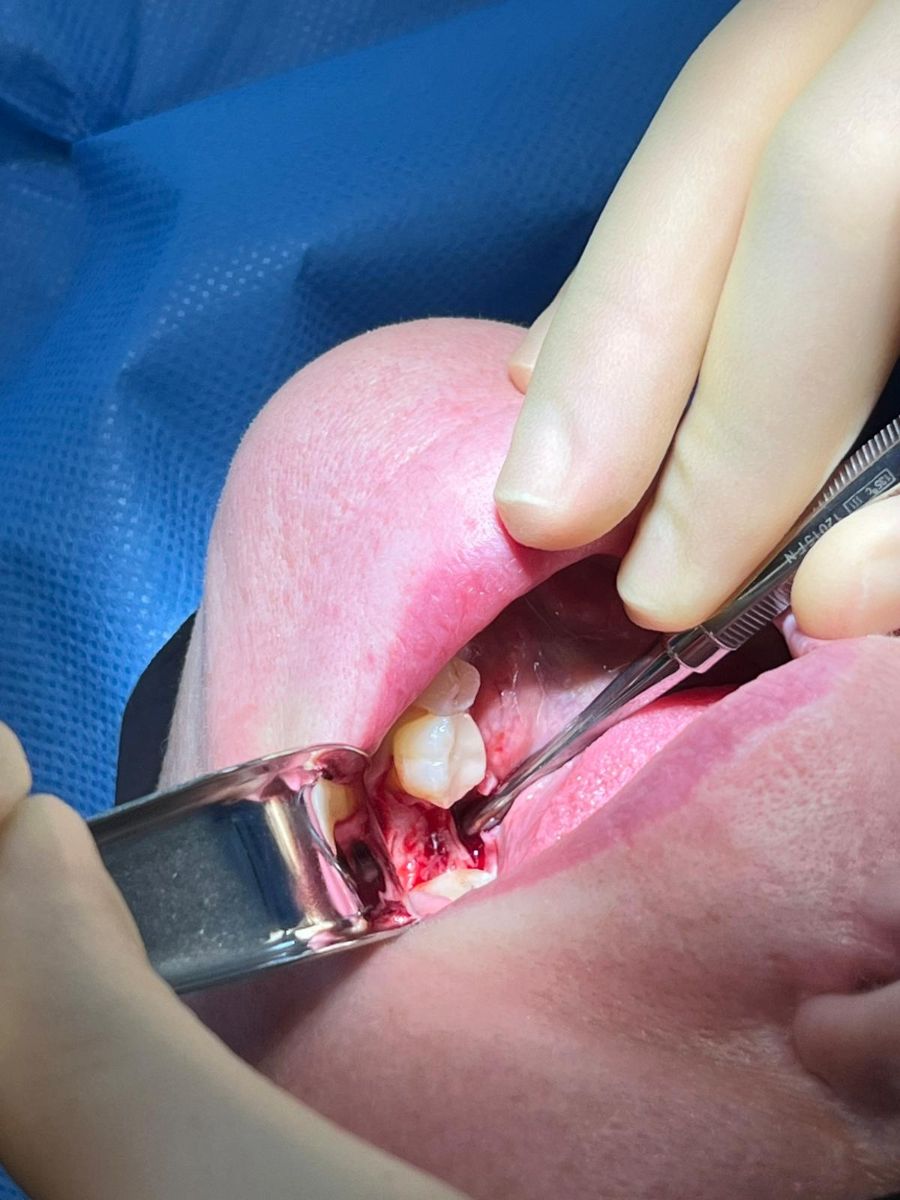 Dental implant case 2, stage 1 of 3